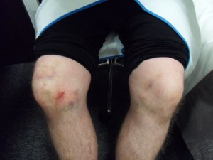 Bruise knees